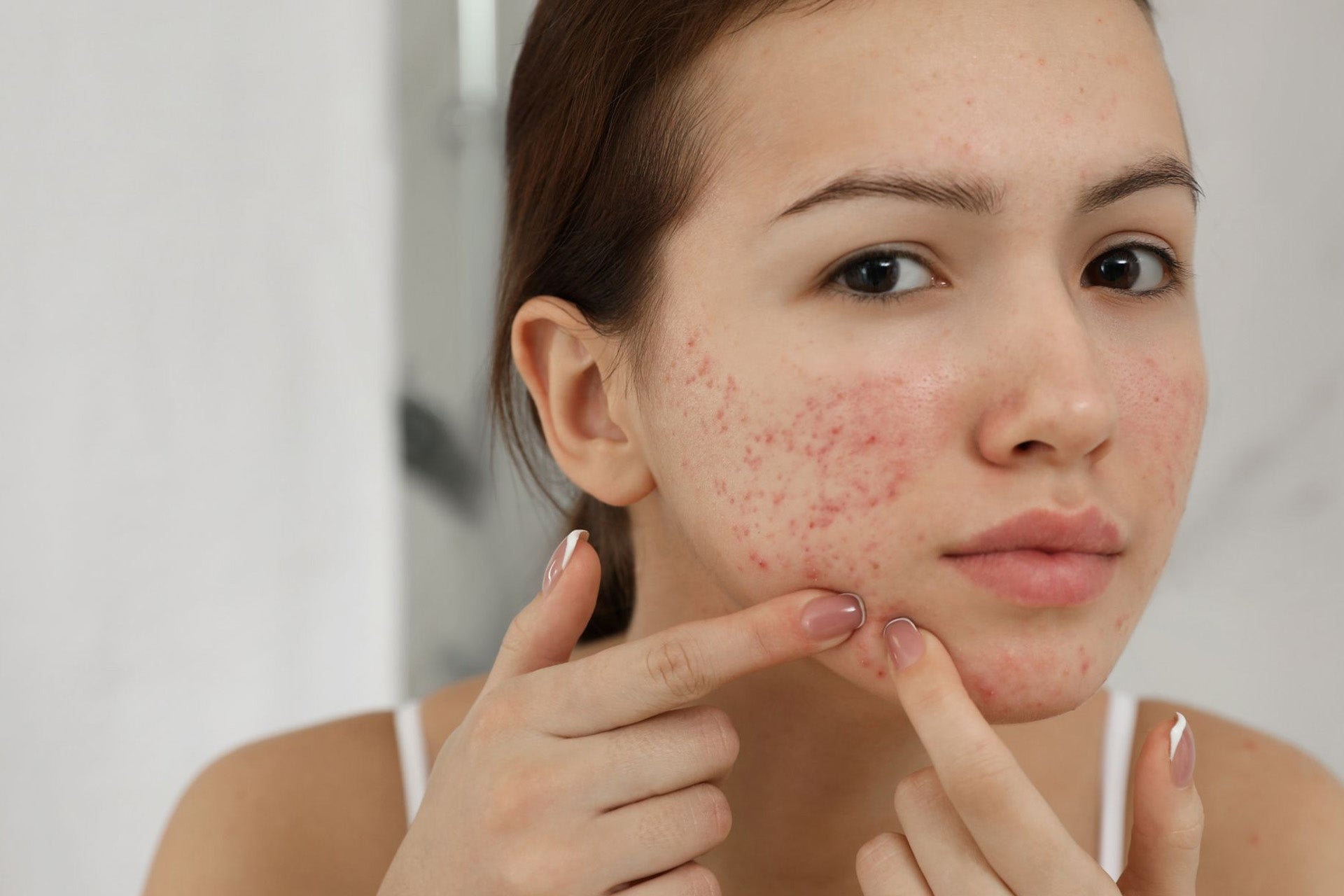 Understanding Acne: Causes, Types & Solutions