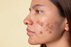 Your Ultimate Guide to Pigmentation: Causes, Treatments & Best Skincare Solutions