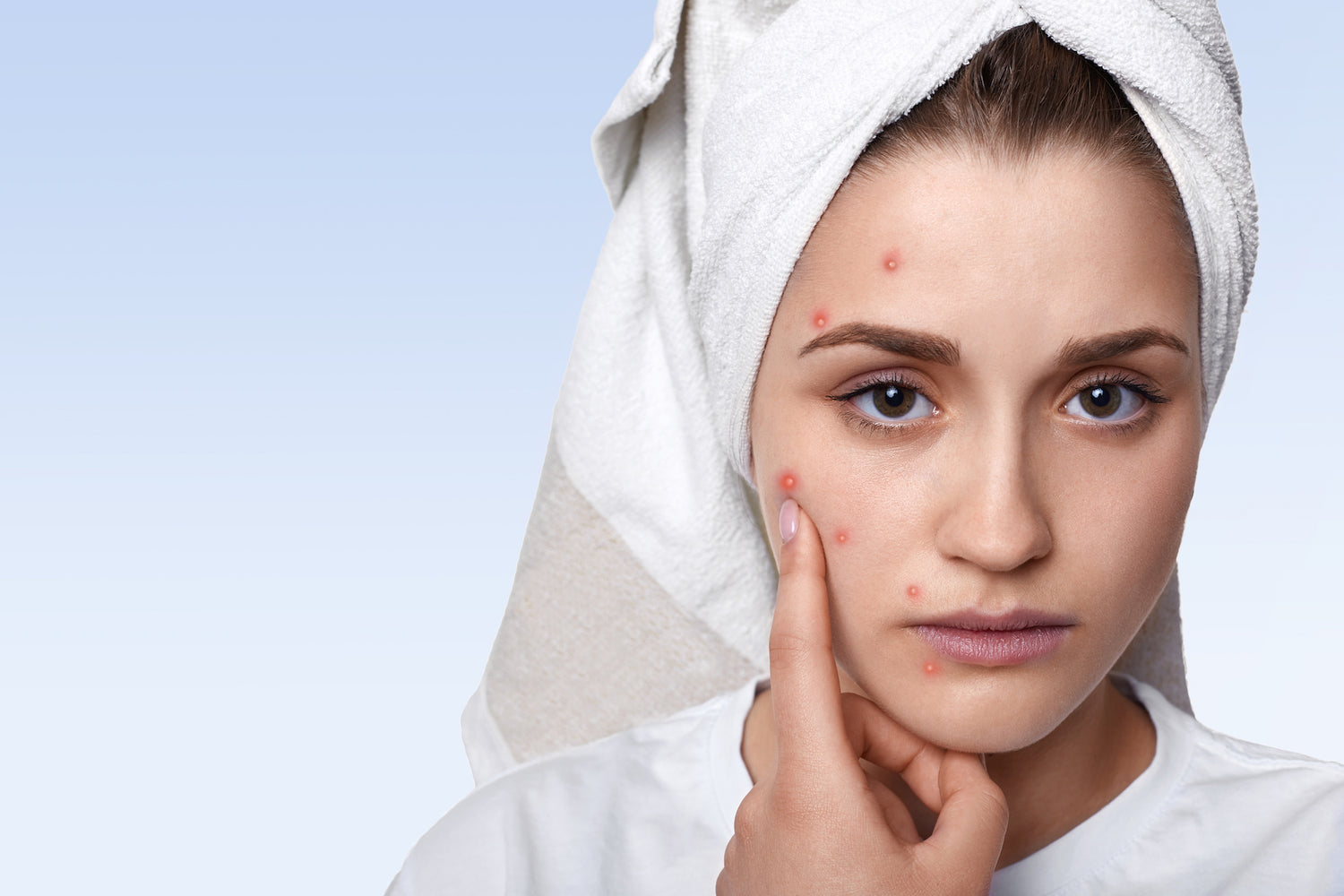 Struggling with Summer Acne? Learn about the types, causes, and effective treatments.