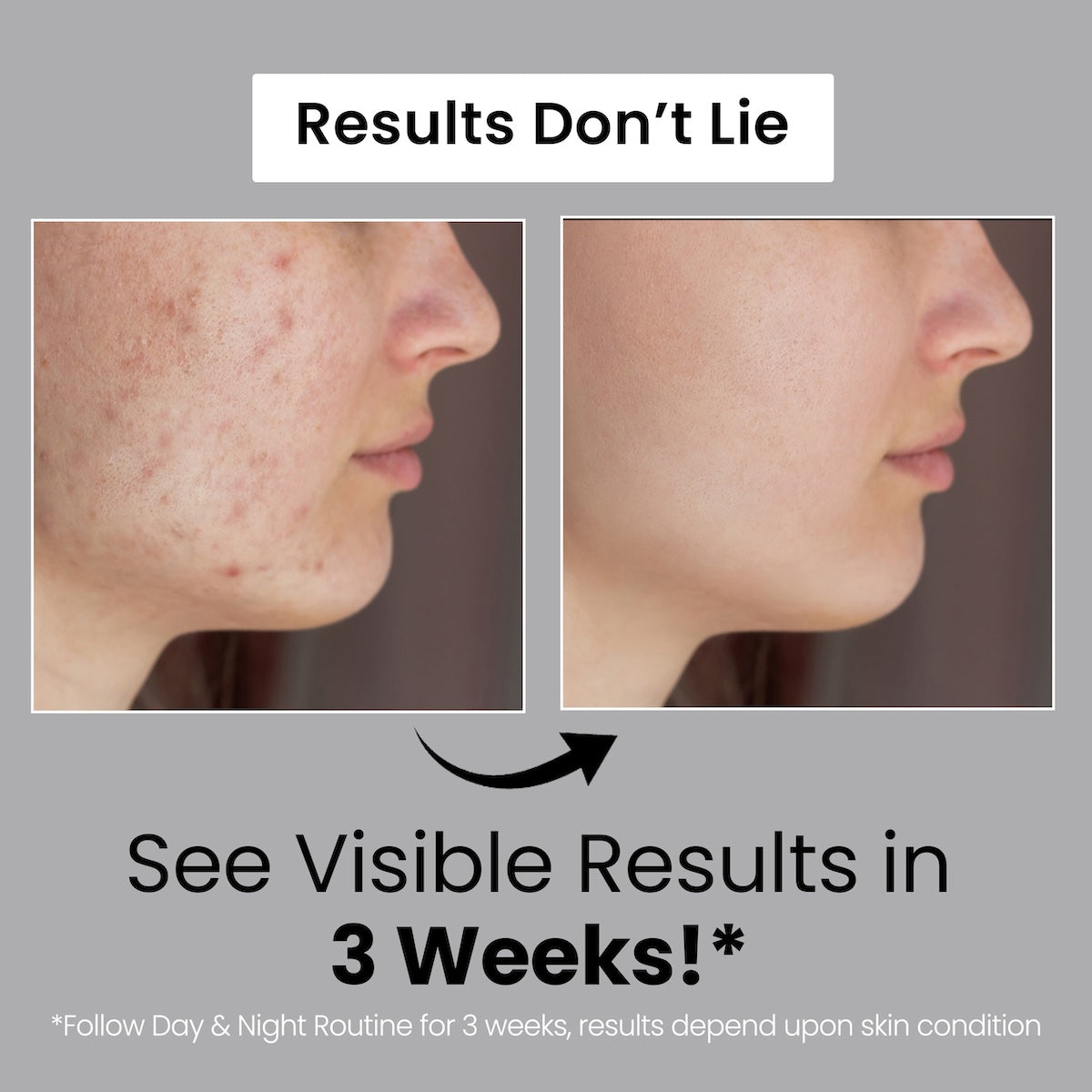 Anti Acne Medicated Treatment Kit (FREE Anti Acne Soap of MRP-190)