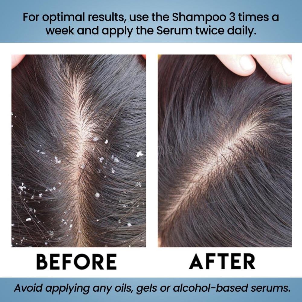 Ultimate Anti Dandruff Anti Hairfall Combo (FREE Doctor Consultation)