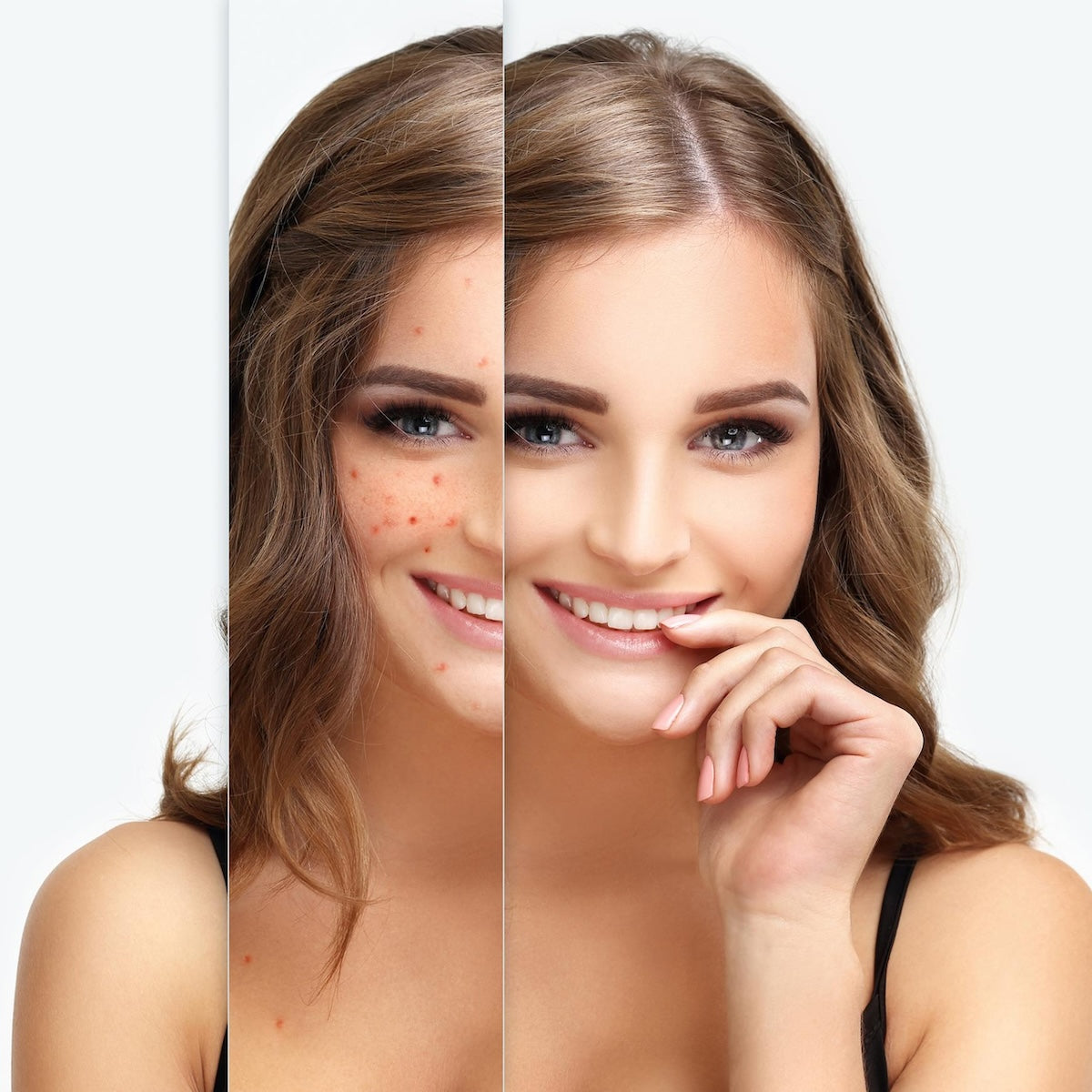 Anti Acne Medicated Treatment Kit (FREE Anti Acne Soap of MRP-190)