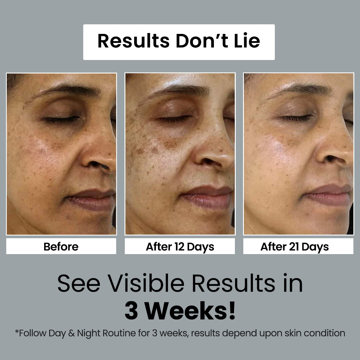 Pigmentation Medicated ZEROOUT Kit (FREE DOCTOR CONSULTATION & FREE Skin Brightening Soap @225/-)